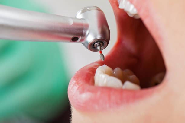 Best Emergency Treatment for Dental Infections or Abscesses in Breaux Bridge, LA